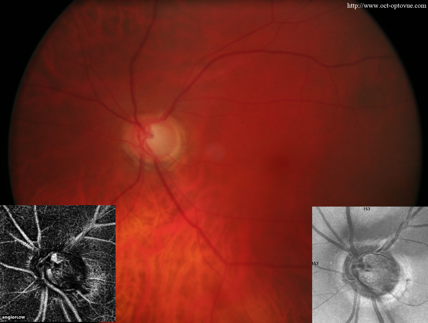 oct-angio glaucoma optovue angiovue