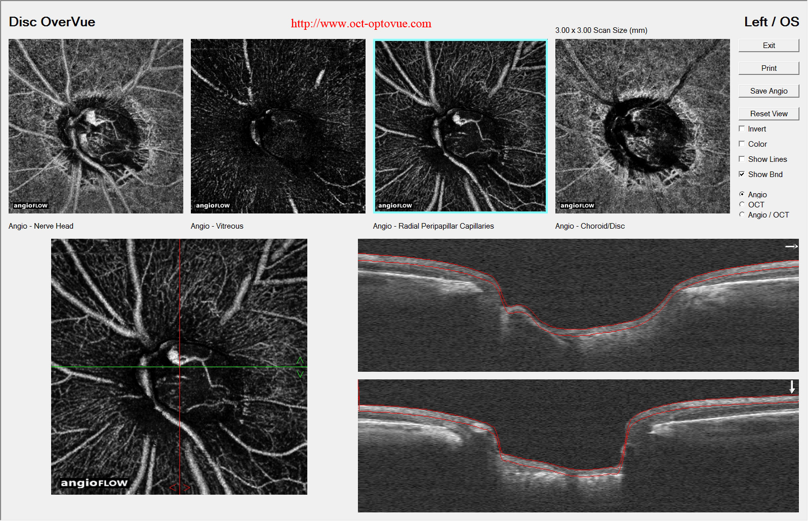 octa glaucoma french ophthalmology