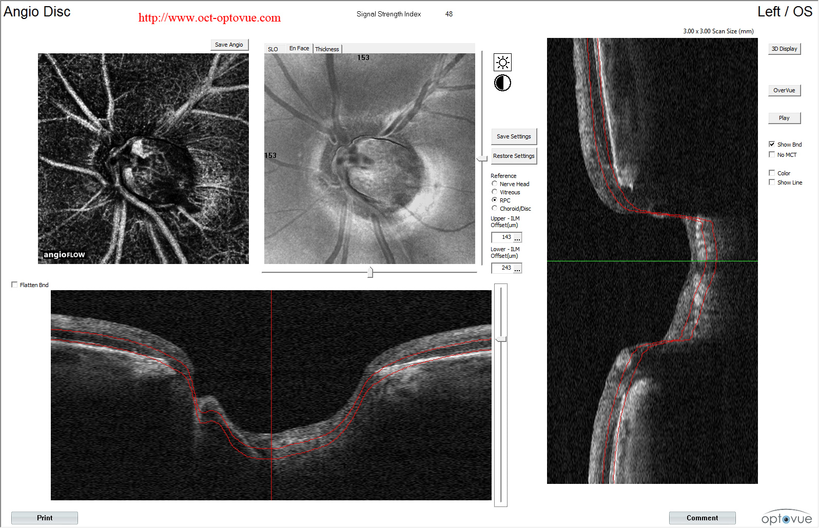 octa glaucoma glaucome optic nerve muratet