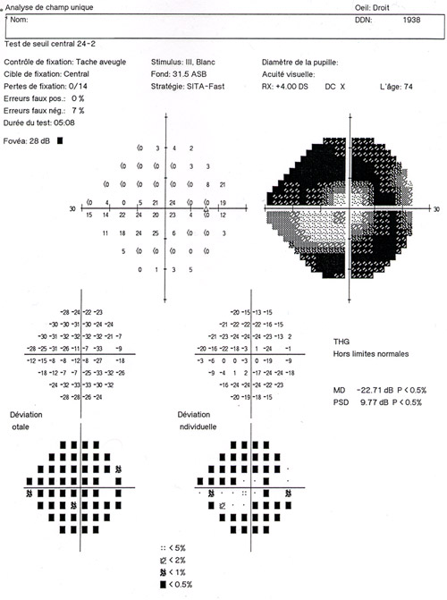 field cv glaucoma glaucome champ visuel