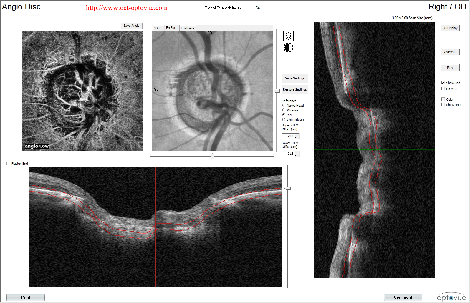 glaucoma-angio-oct blind papilla