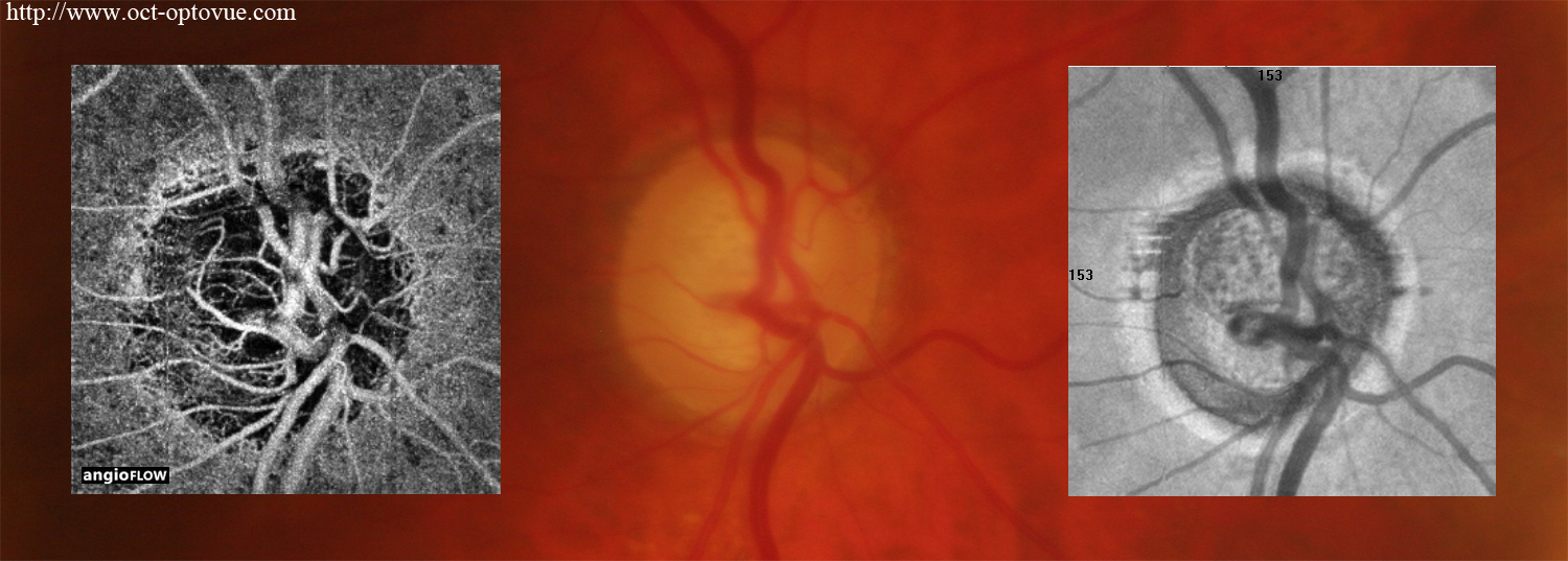 glaucoma-angio-oct