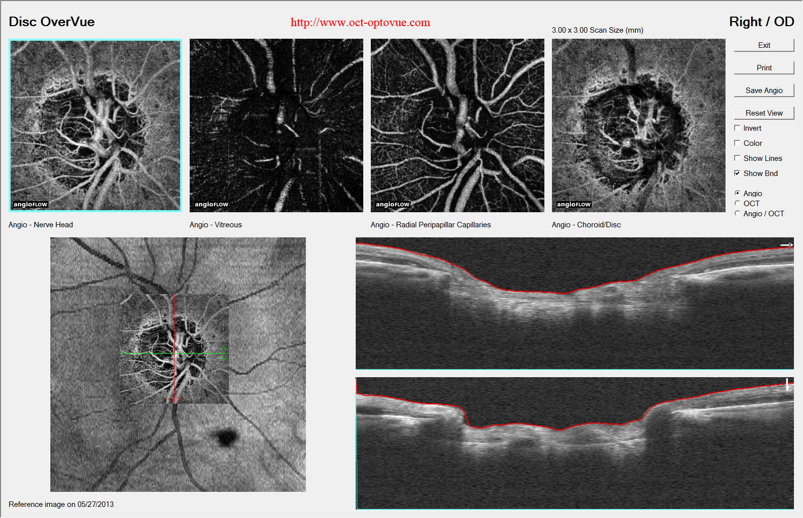  papilla glaucoma angio-oct 