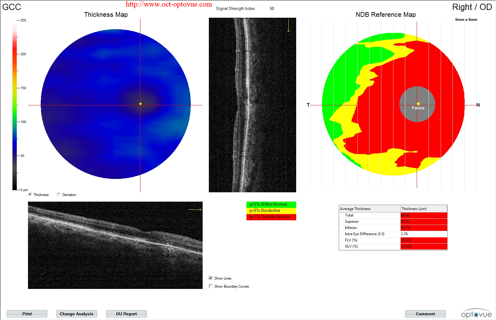 glaucoma gcc angio