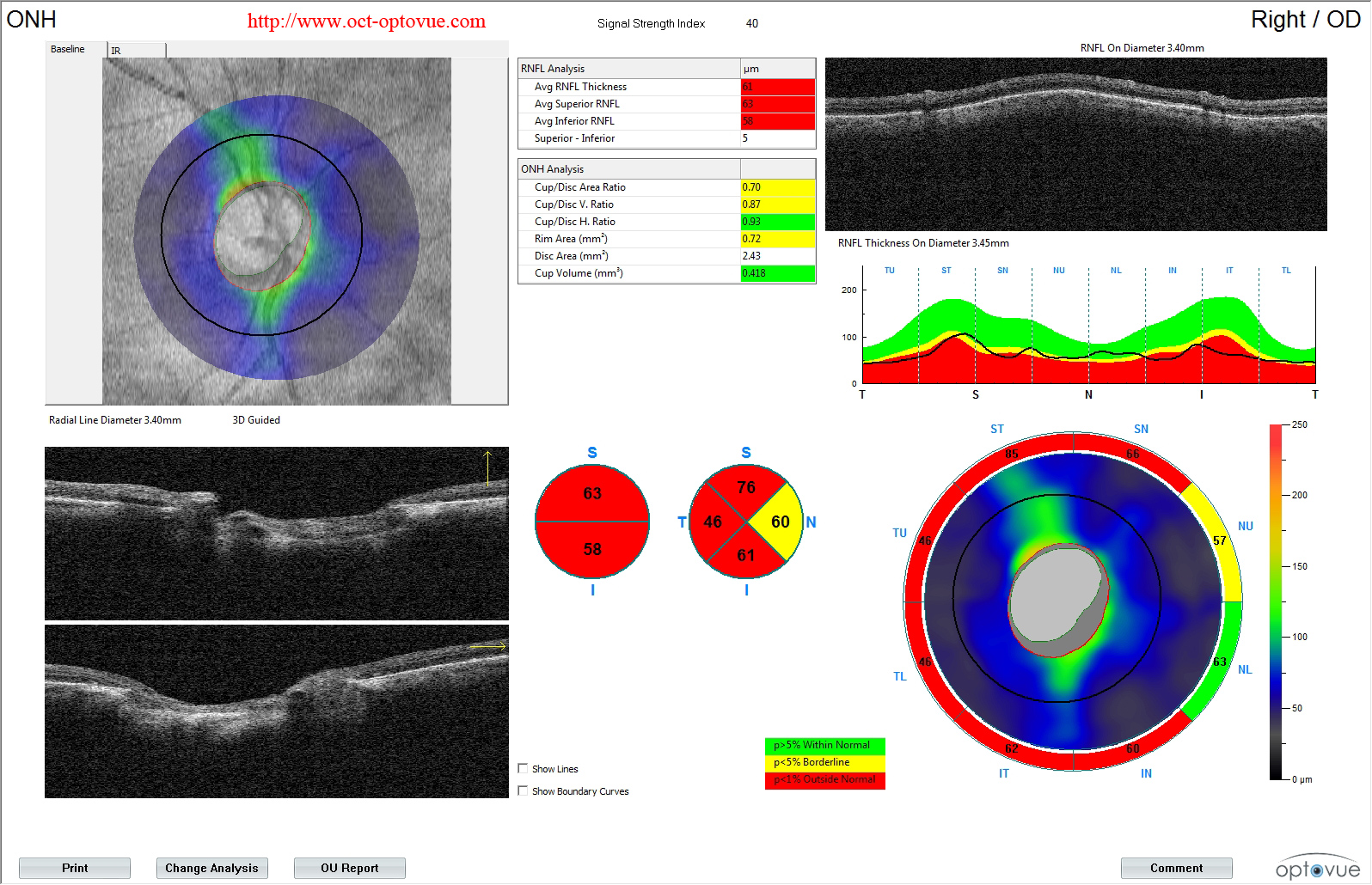 glaucoma rnfl angio