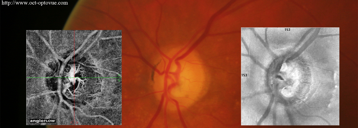 octa glaucoma blindness
