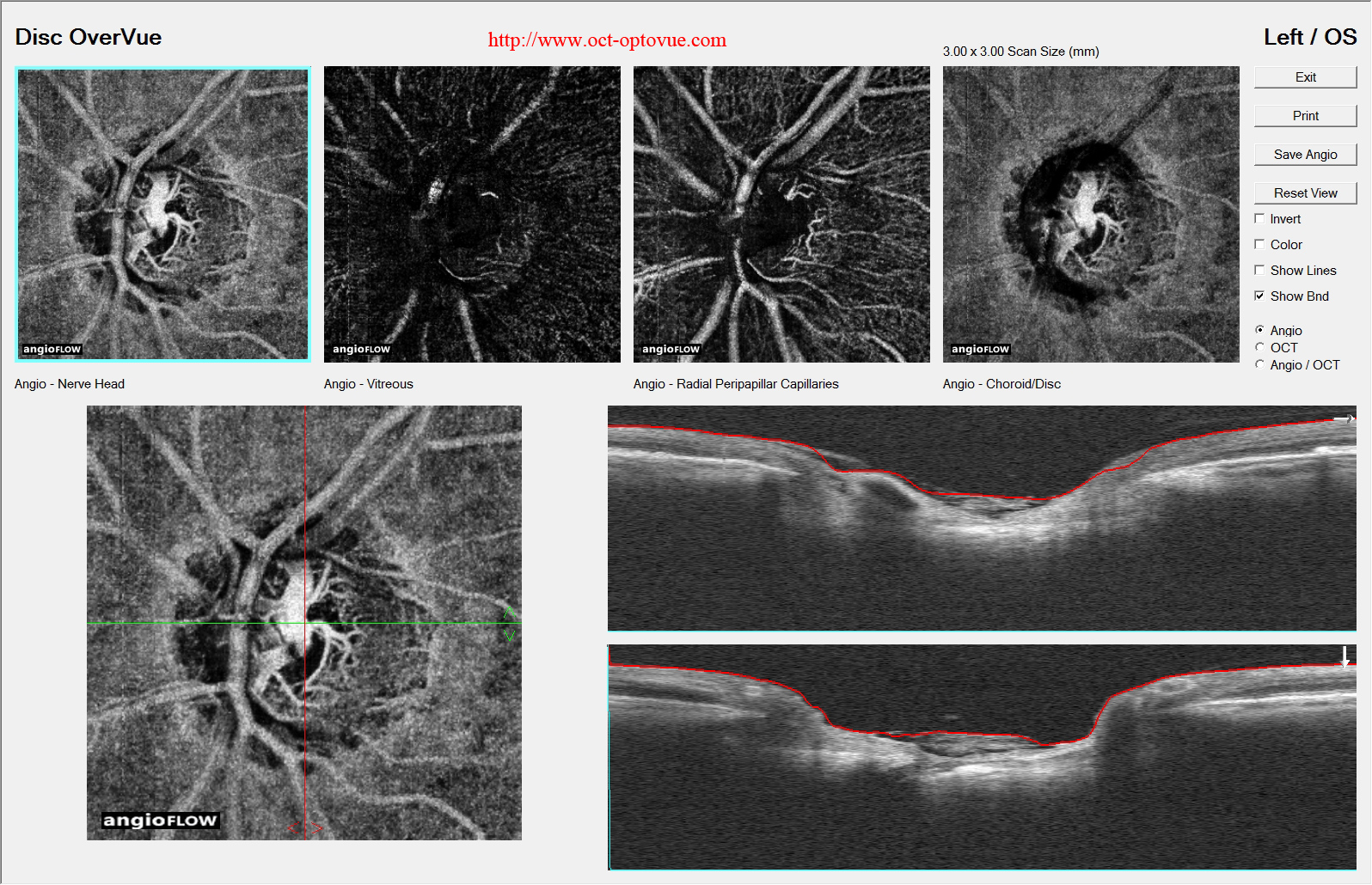 octa glaucoma optovue angioflow