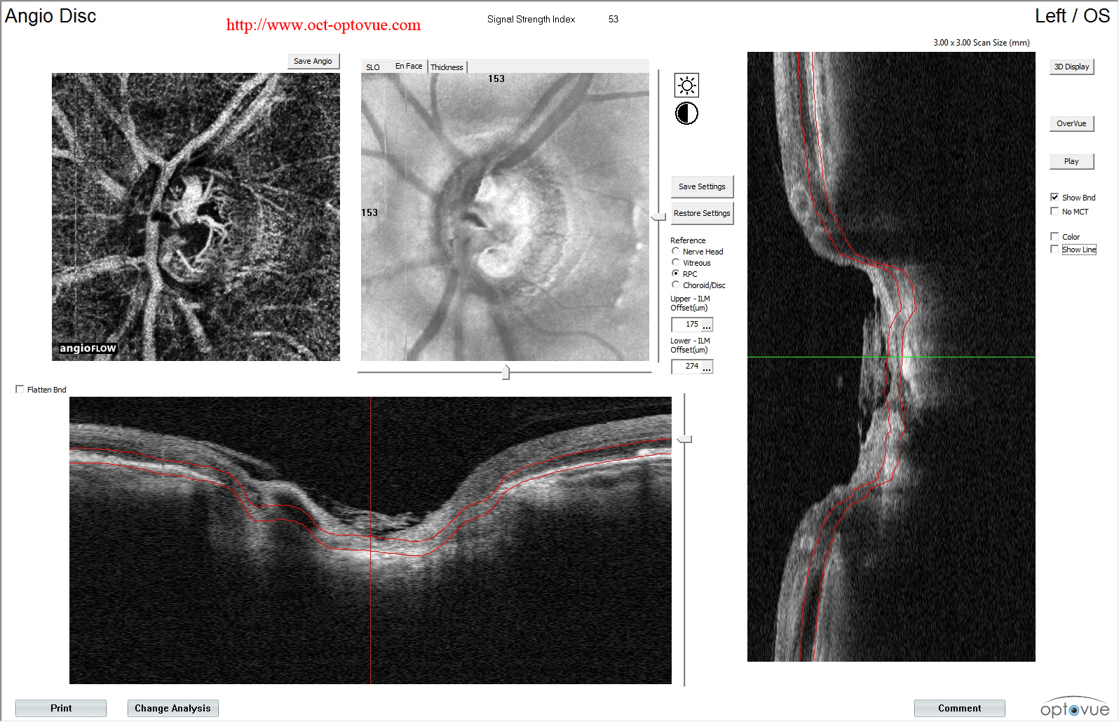 octa glaucoma disease cecite jean-michel muratet