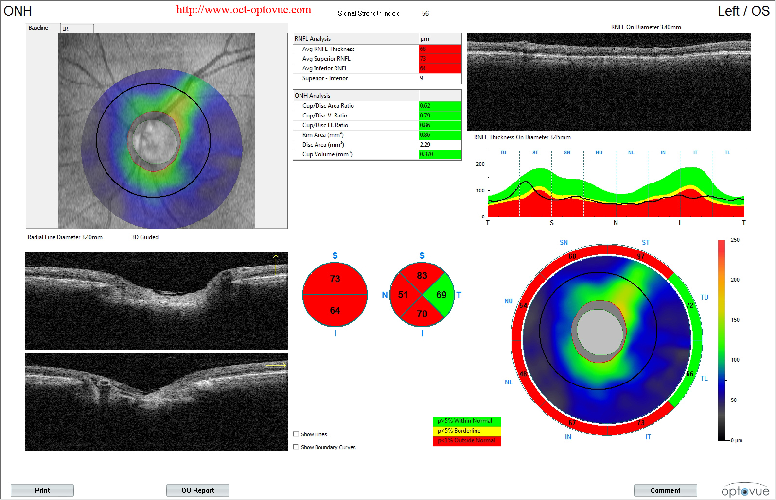 octa glaucoma rnfl