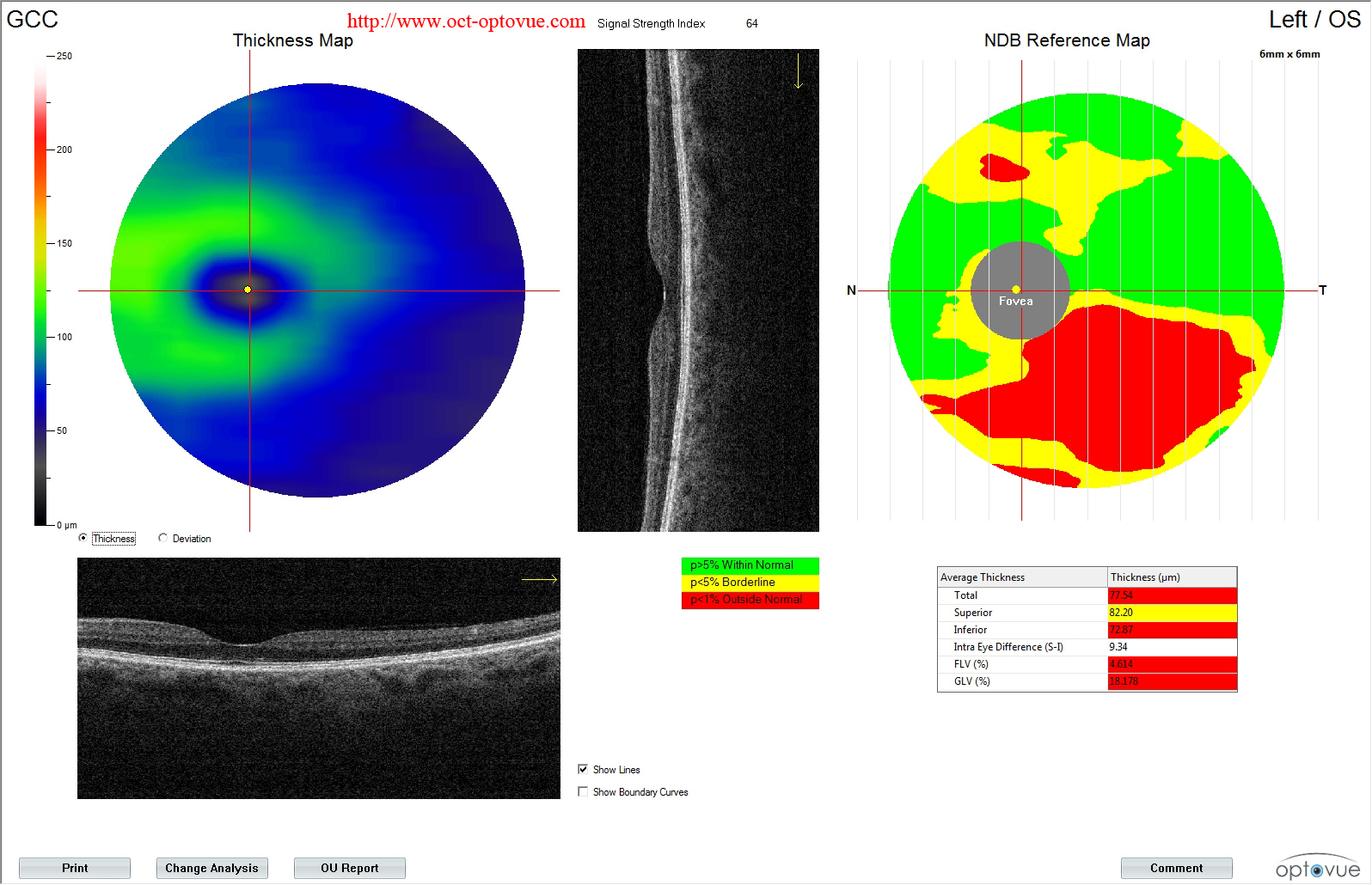 octa glaucoma gcc rnfl