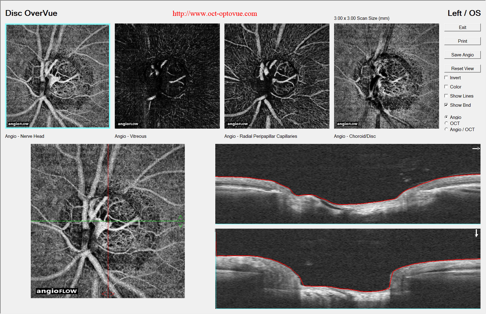 octa glaucome disease glaucome blindness