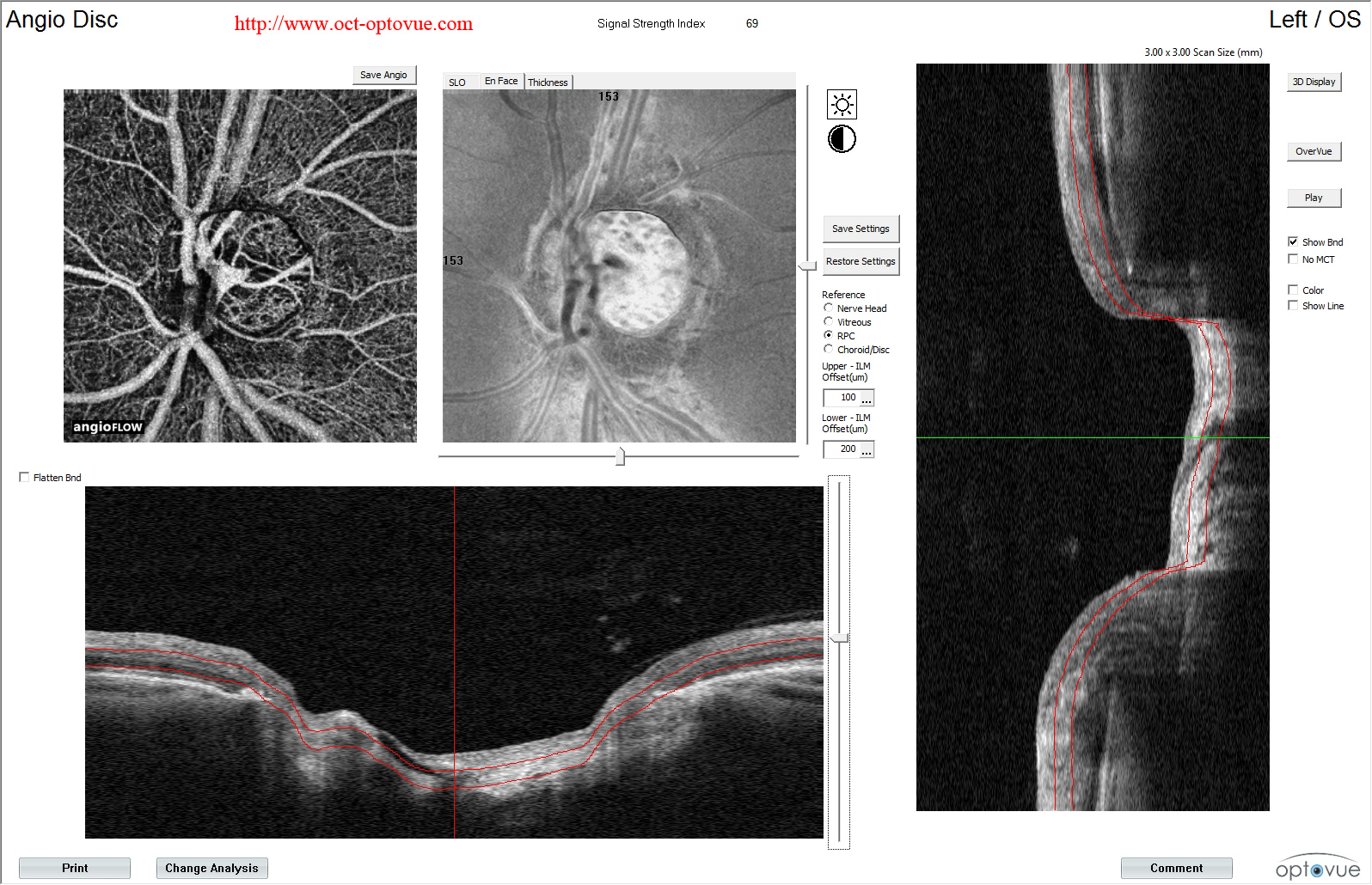 octa glaucome disease glaucome blindness