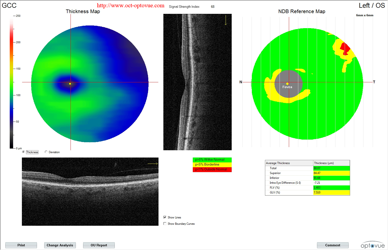 octa glaucome disease glaucome blindness