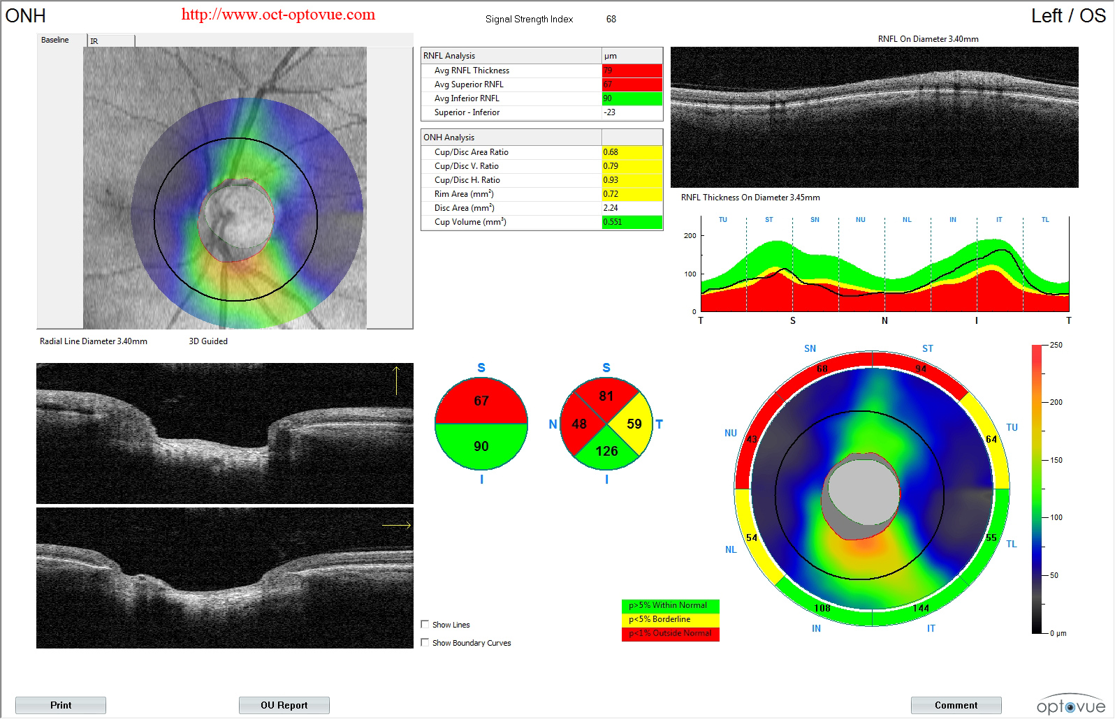 octa glaucome disease drops glaucome blindness