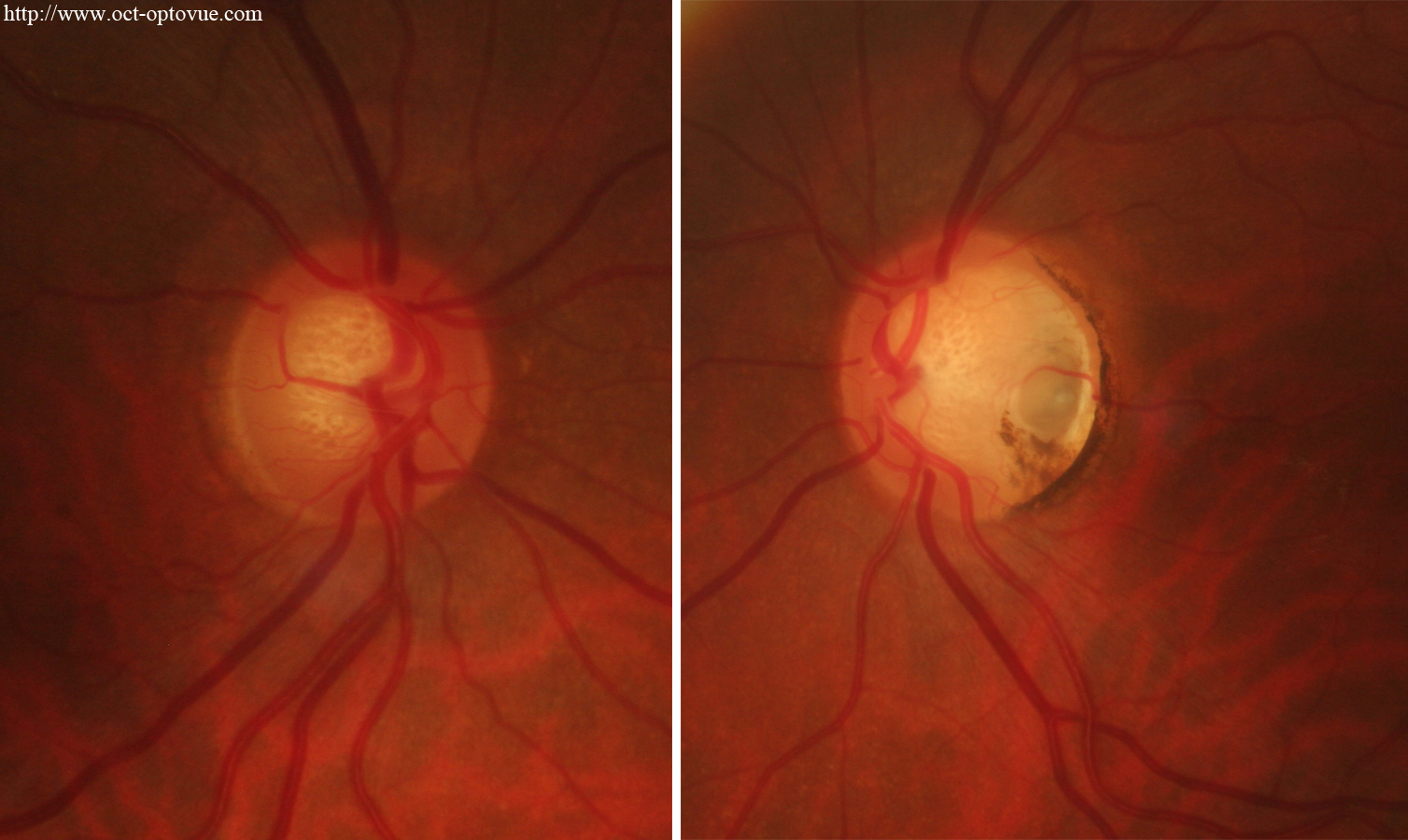 octa-glaucoma-angio