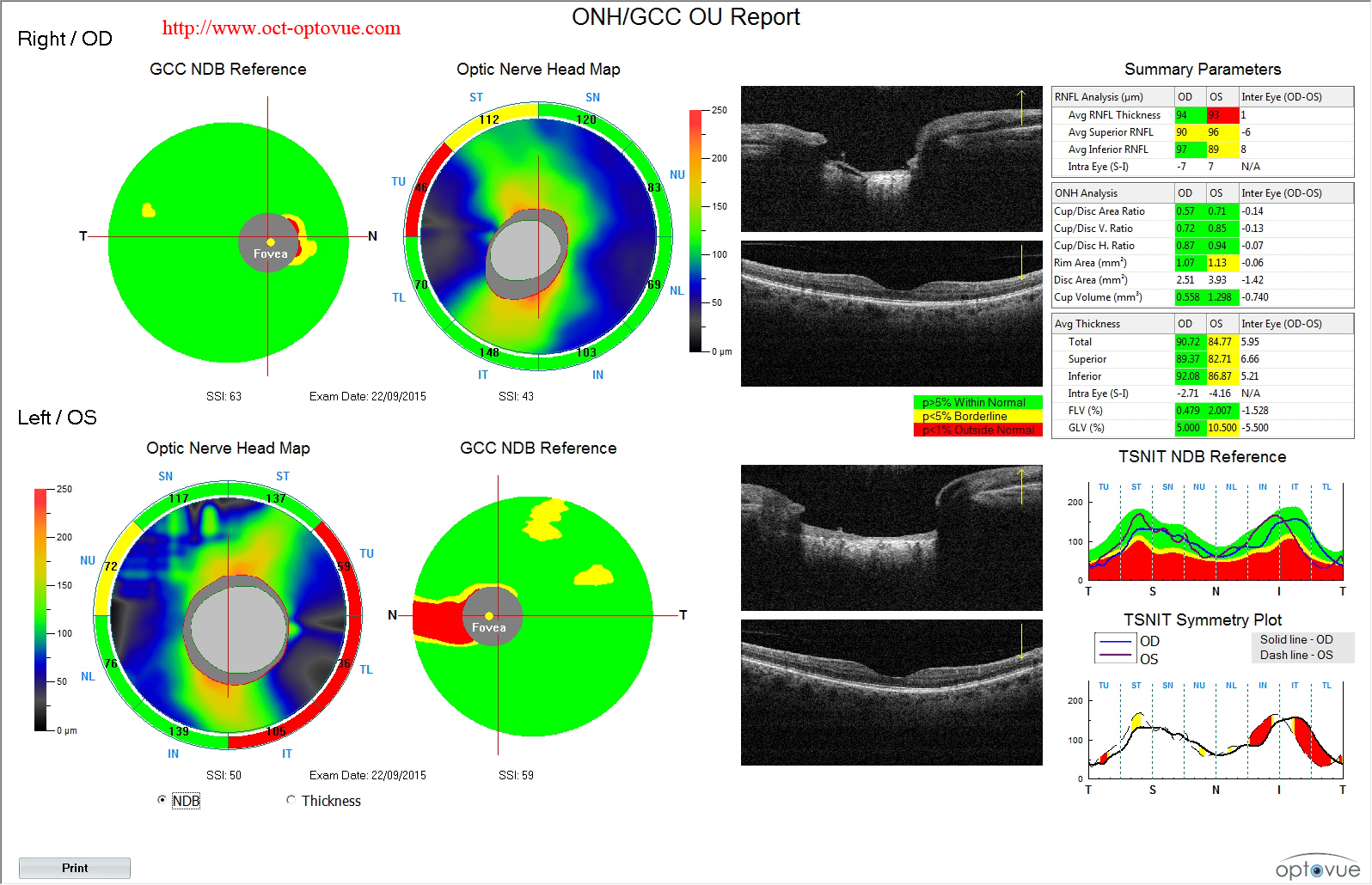 octa-glaucoma-gcc