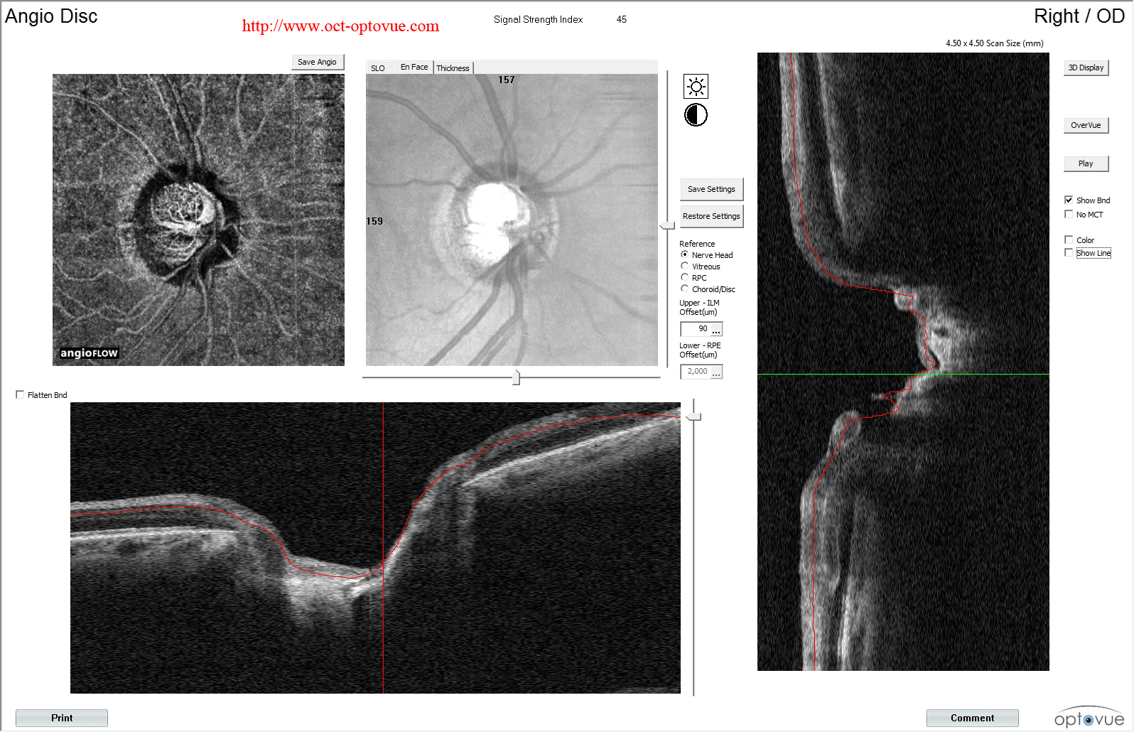 octa-glaucoma-od-angio