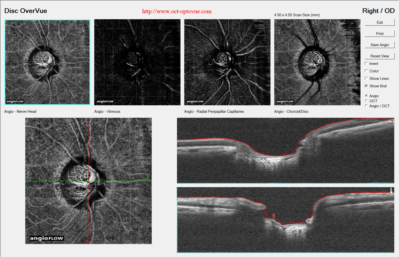 octa-glaucoma-od