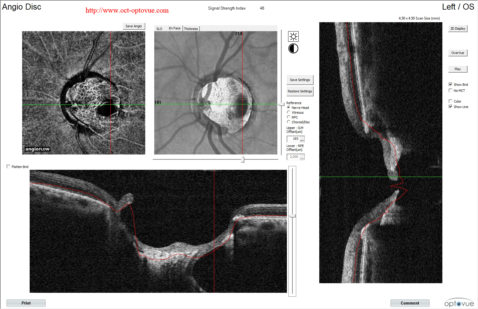 octa-glaucoma-og-angio