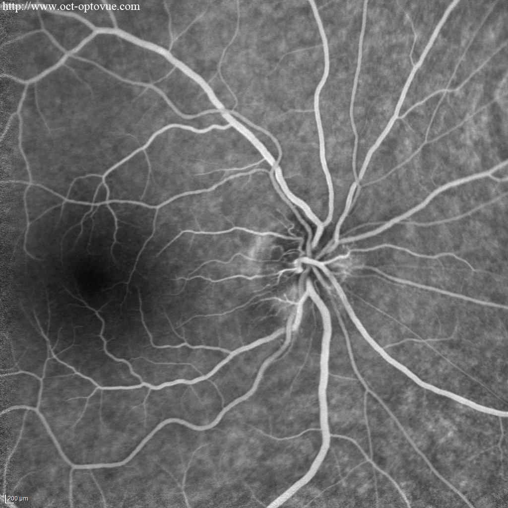 Fluorescein angiography optic-neuropathy