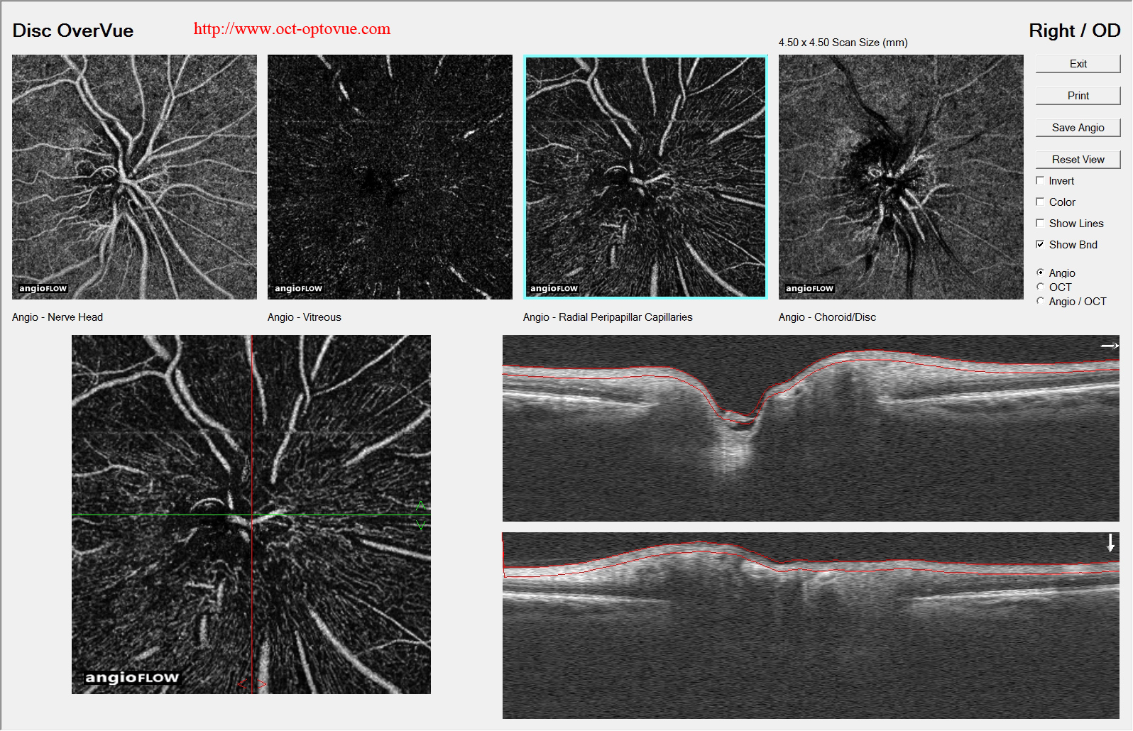 optic-neuropathy oct-angiography