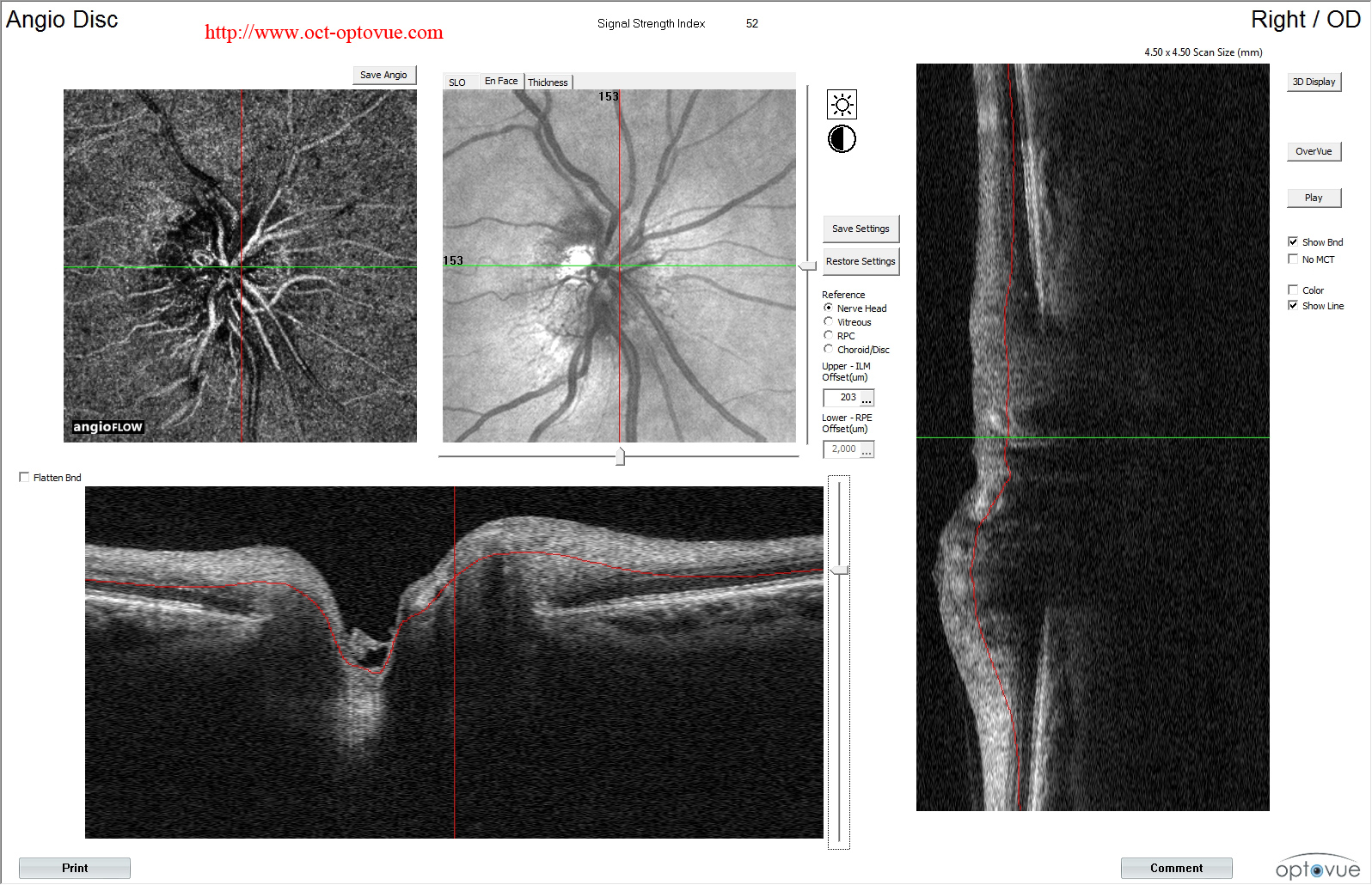 optic-neuropathy oct