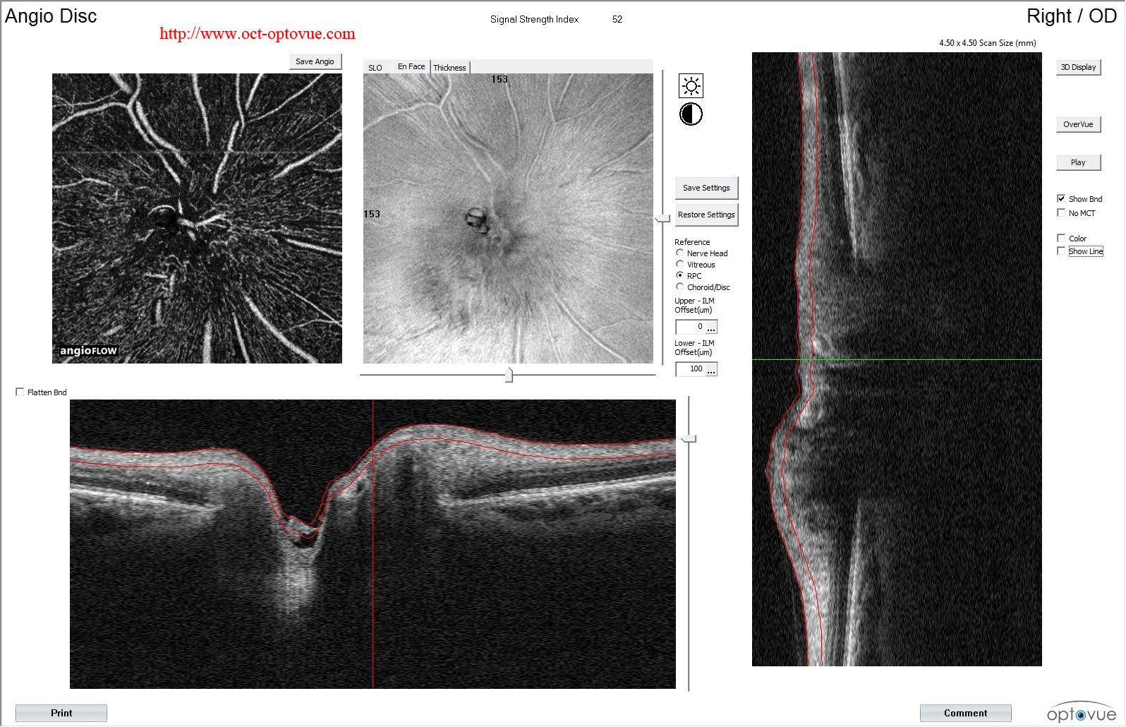 optic-neuropathy octa neuropathie optique