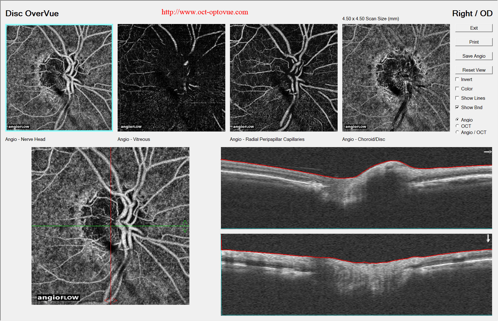 AION NOIAA angiography-OCT