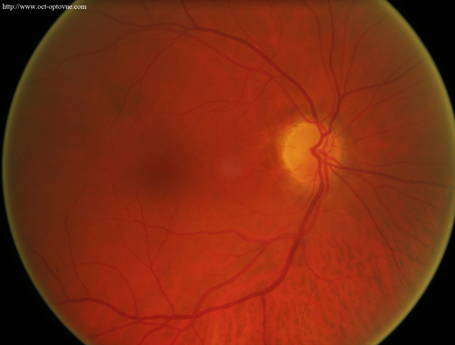 anterior-ischemic-optic-neuropathy AION NOIAA