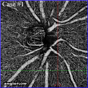 angio oct papilla optic nerve retina optovue