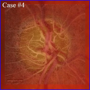 glaucoma angio-oct glaucome cecite