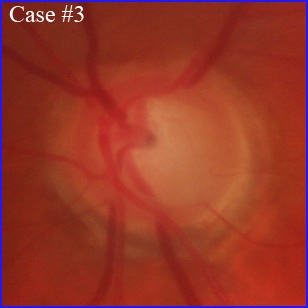 oct-angio-glaucoma blindness