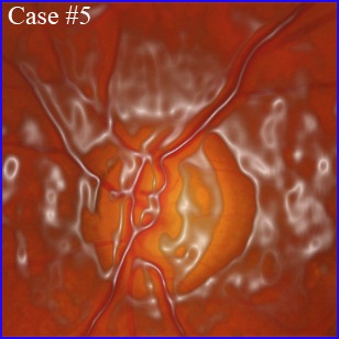 octa-glaucoma artist effect :-)