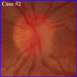 papilla-black oct angiography nerve disc