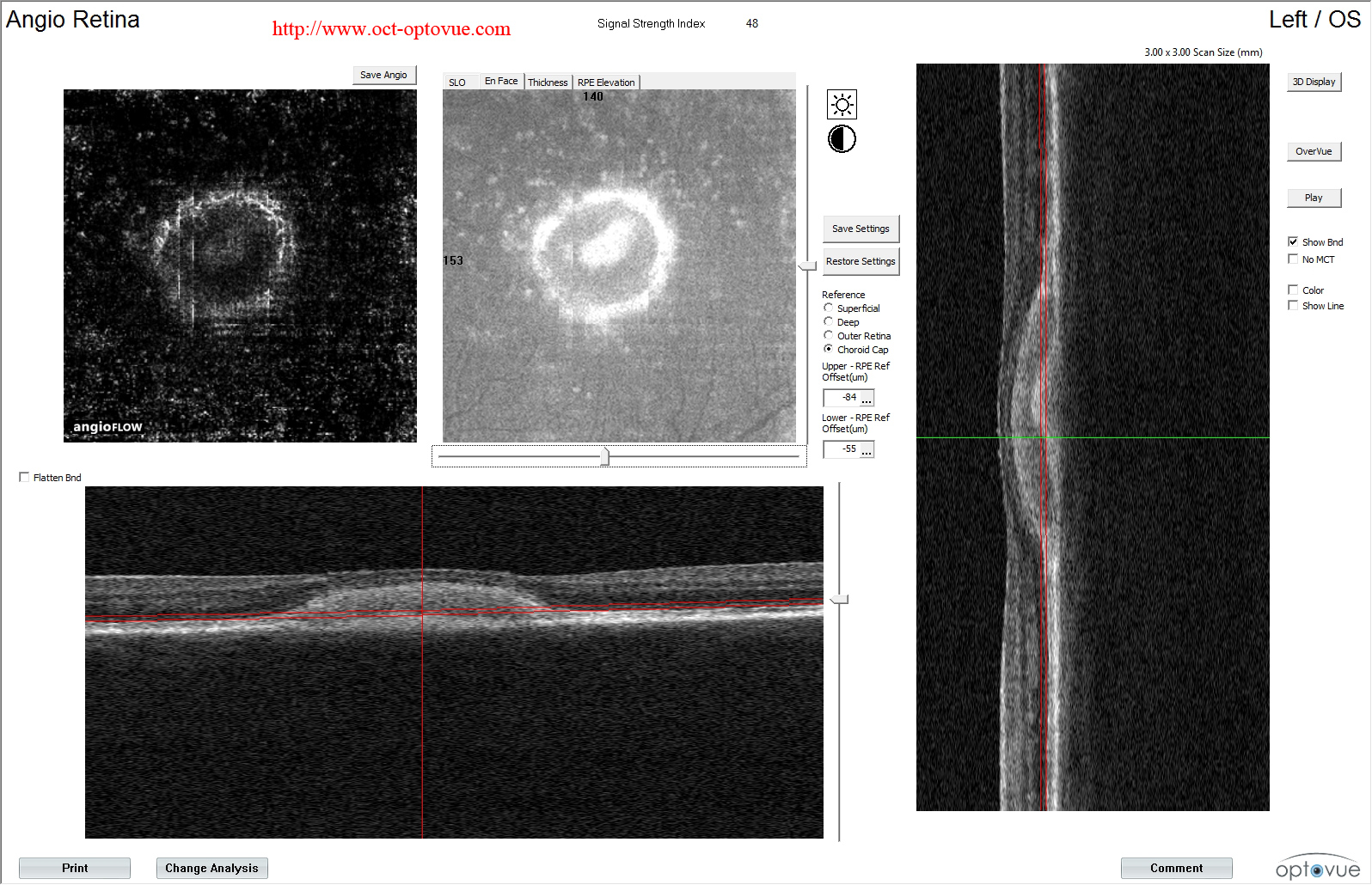 pseudovitelliform maculopathy oct-angiography ARMD