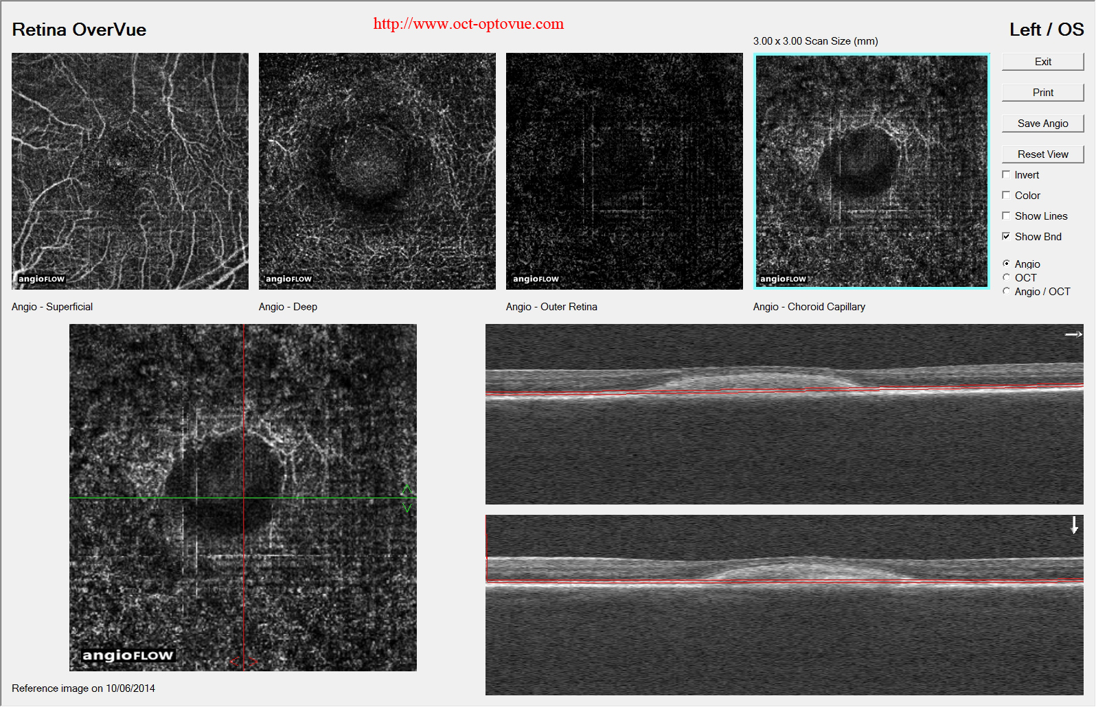 pseudovitelliform maculopathy oct-angiography amd