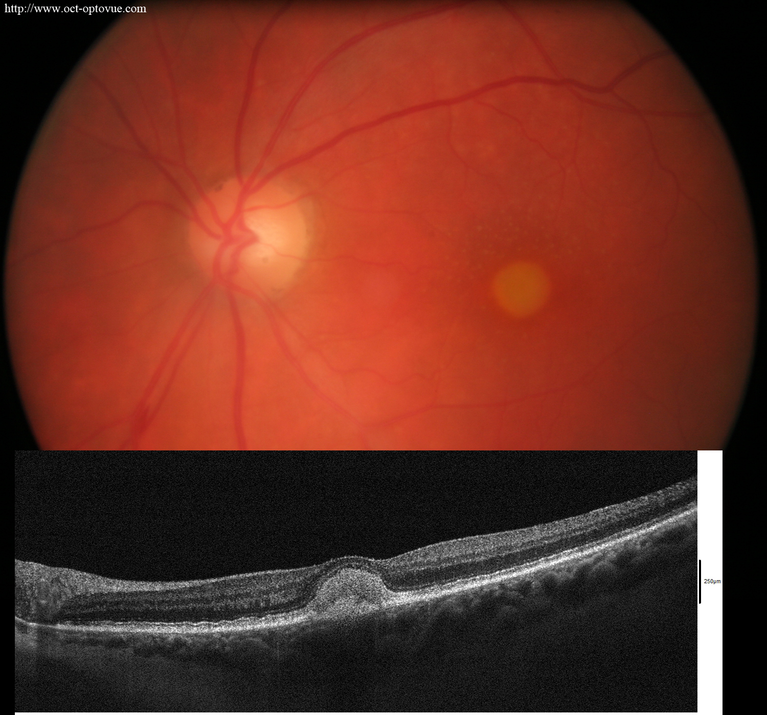 pseudovitelliform maculopathy oct-angiography