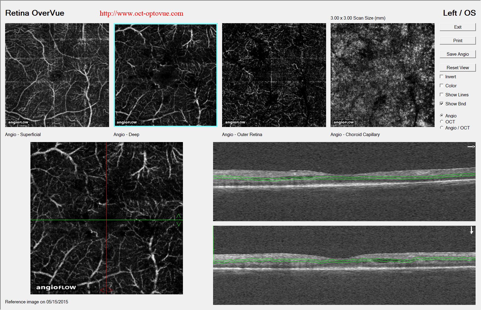 birdshot retinopathy oct angiography