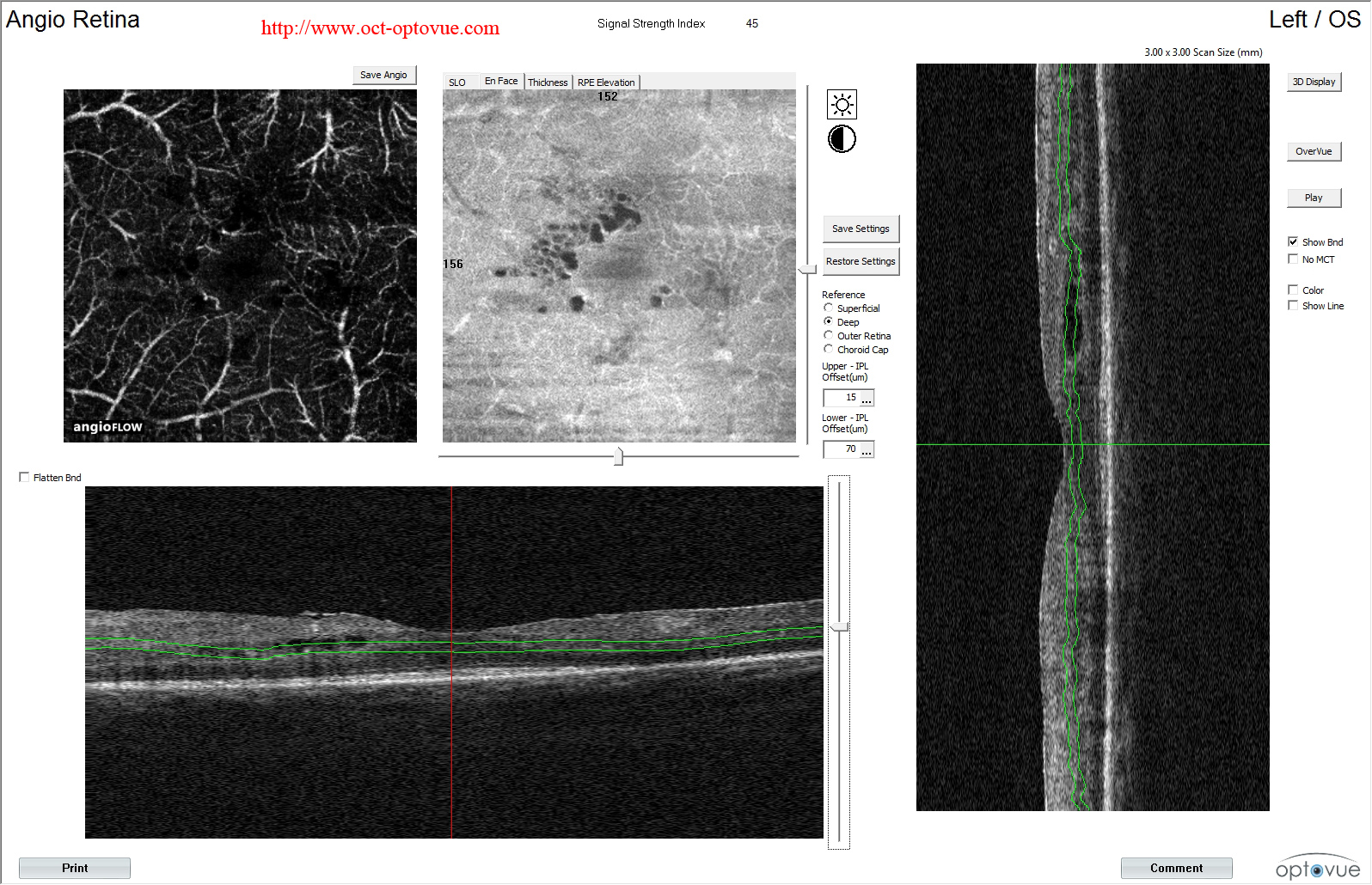 birdshot retinopathy oct angiography