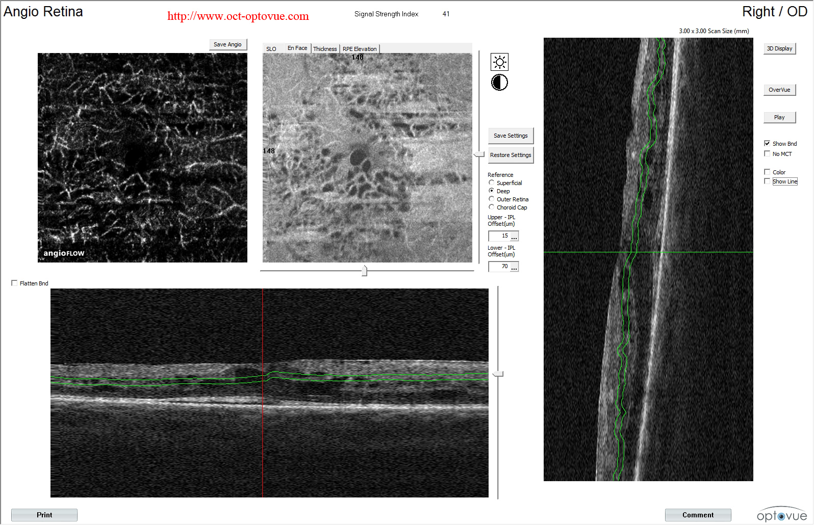 birdshot retinopathy oct angiography