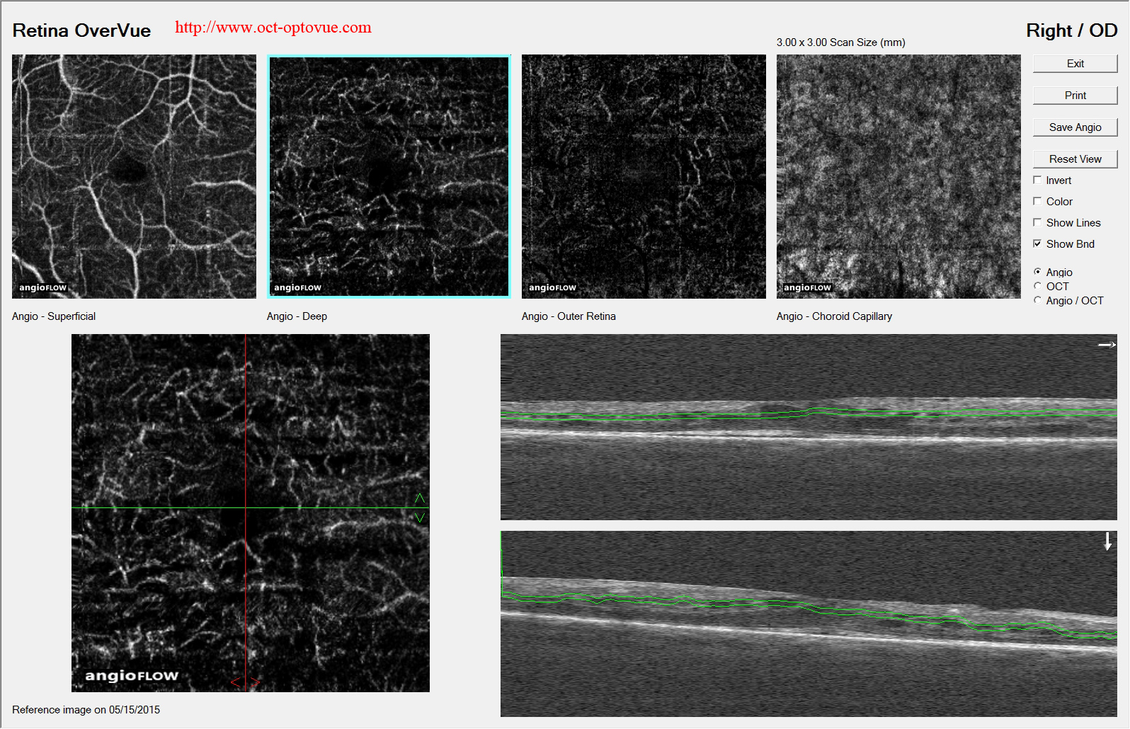 birdshot retinopathy oct angiography