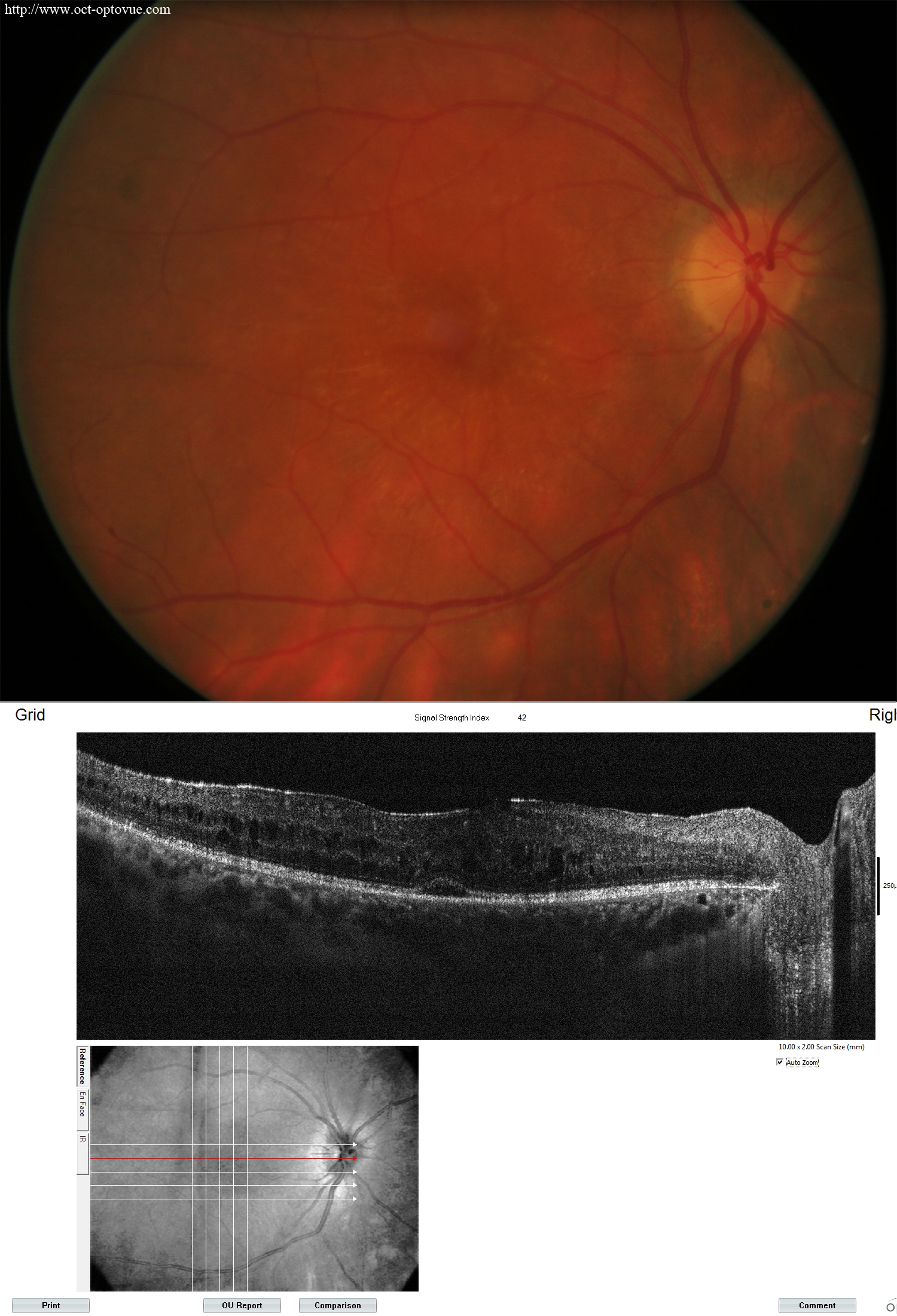 birdshot retinopathy oct angiography