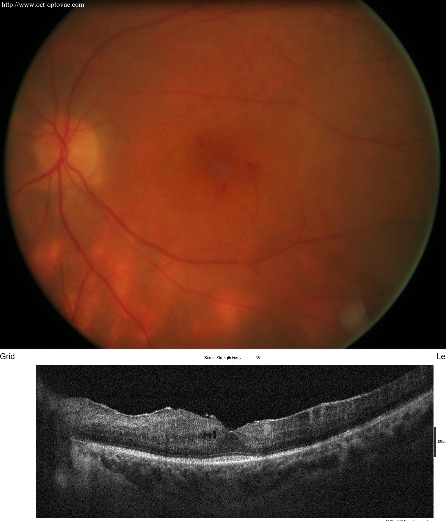 birdshot octa retinopathy
