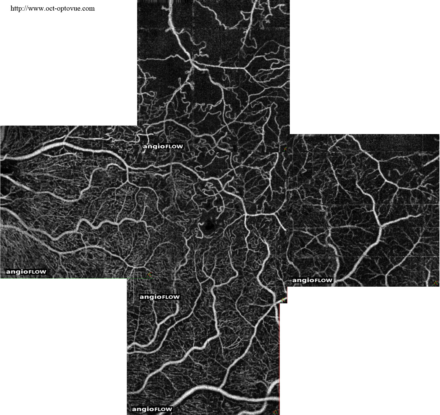 panoramic oct-angio rvo ischemic