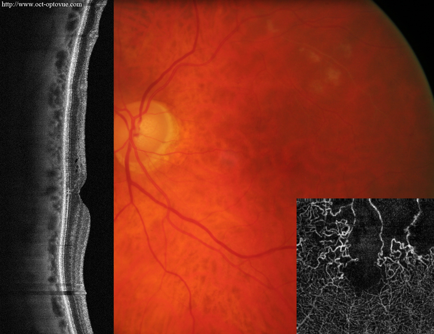 ischemic angio-oct