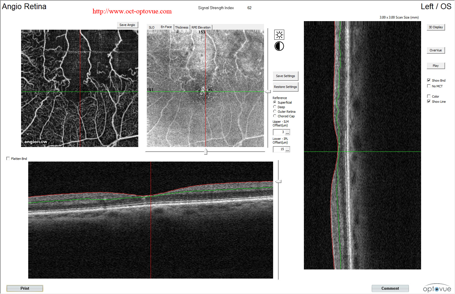 ischemic-angioct muratet oct angio