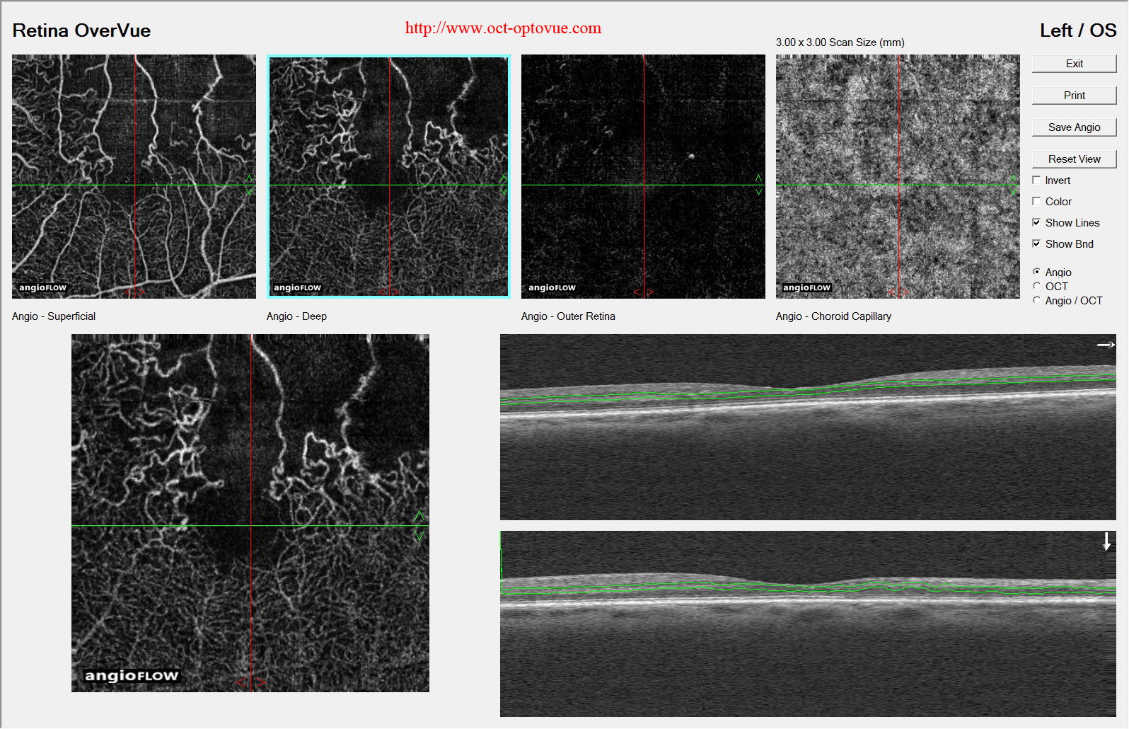 ischemic vascular-oct