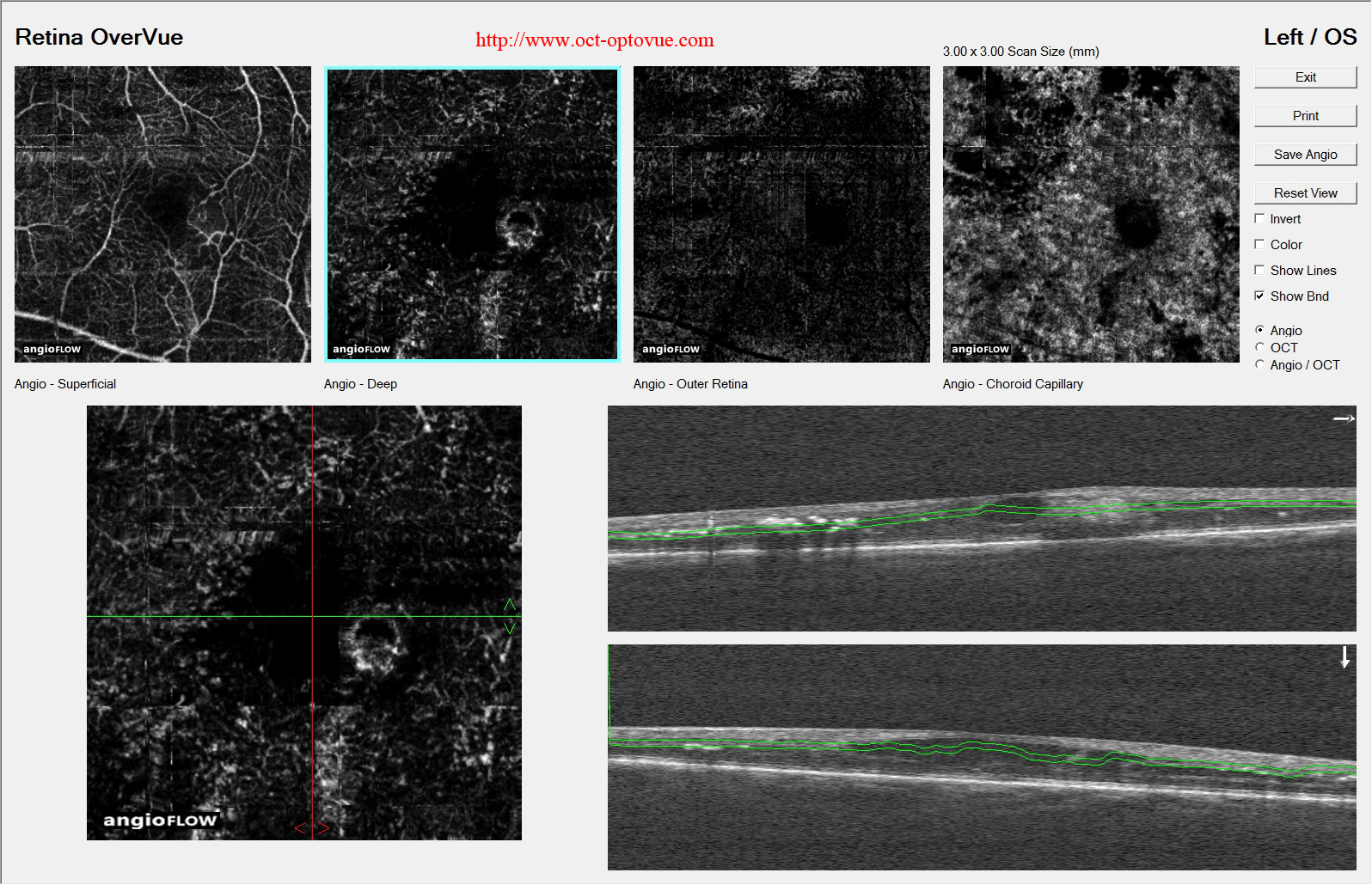 retinal macroaneurysm oct-angiography