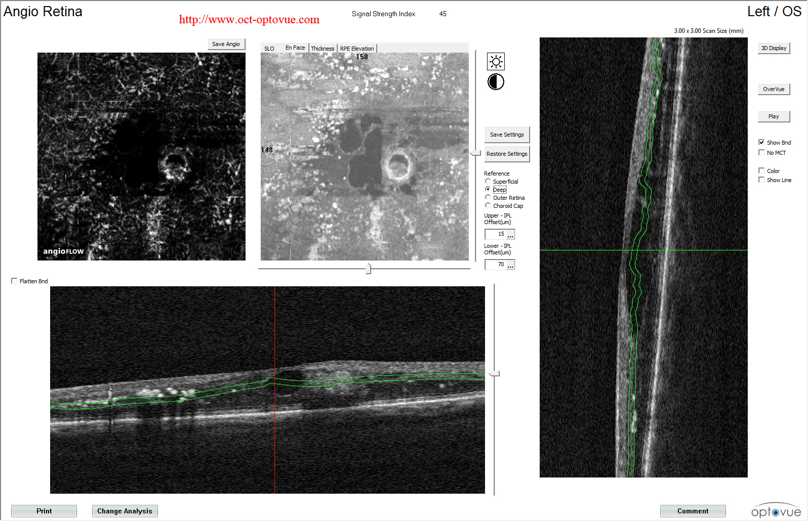 retinal macroaneurysm oct-angiography