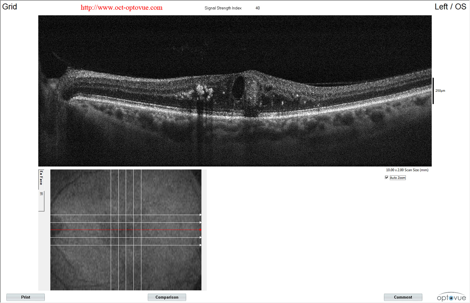 retinal macroaneurysm oct